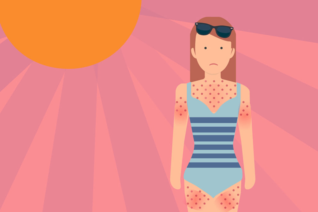 Got a sun rash on your last vacation? It might be a sun allergy.
